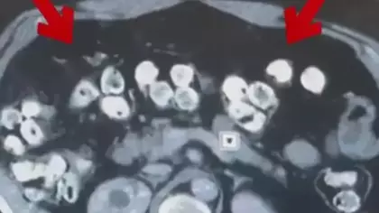 2 kilo 675 gram Afyon sakızı yuttuğu tespit edilen 3 şüpheli tutuklandı