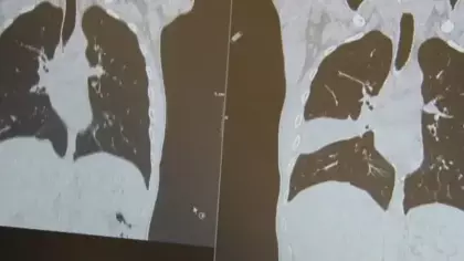Akciğerindeki lezyon kanser sanıldı: Gerçek ameliyatta ortaya çıktı