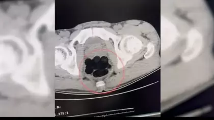 Batman'da akılalmaz olay: Röntgen gerçeği ortaya çıkardı
