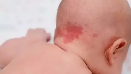 Doğum lekelerine dikkat: Nörolojik hastalıkların habercisi olabilir!