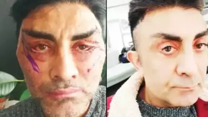 Gençleşmek istedi, hayatı kabusa döndü! 4 ameliyat oldu, gözlerini kapatamıyor