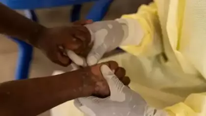 Güney Afrika’da son 5 haftada 13 kişide M çiçeği vakası kaydedildi