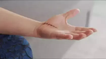 Her yara izi kalıcı olmak zorunda değil: Skar tedavisinde lazer ve PRP öne çıkıyor