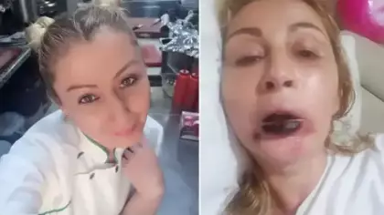 Yaptırdığı işlem sonrası dudağı çürüdü! 7 yıldır kabusu yaşıyor...